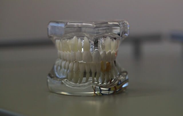 Zęby z implantem