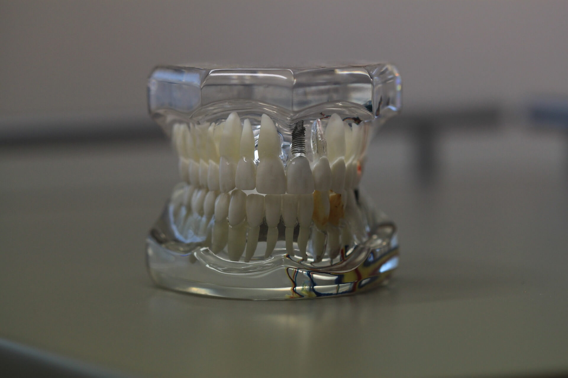 Implanty zębowe - jak wybrać stomatologa